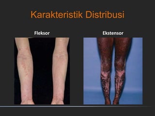 Karakteristik Distribusi
Fleksor Ekstensor
 