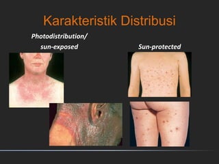 Karakteristik Distribusi
Photodistribution/
sun-exposed Sun-protected
 