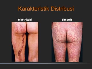 Karakteristik Distribusi
Blaschkoid Simetris
 