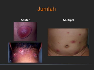 Jumlah
Soliter Multipel
 