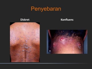 Penyebaran
Diskret Konfluens
 