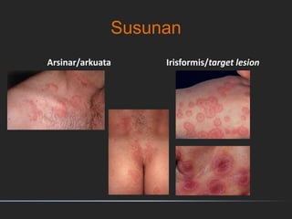 Susunan
Arsinar/arkuata Irisformis/target lesion
 