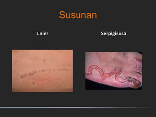 Susunan
Linier Serpiginosa
 