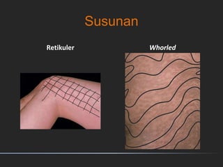 Susunan
Retikuler Whorled
 