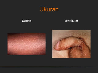 Ukuran
Gutata Lentikular
 