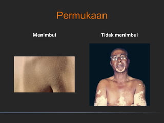 Permukaan
Menimbul Tidak menimbul
 