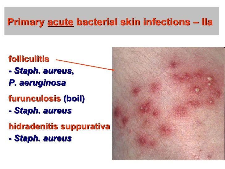 treatment s. skin infection aureus Skin