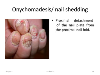 Onychomadesis/ nail shedding
                          • Proximal detachment
                             of the nail plate from
                            the proximal nail fold.




8/5/2012           1212413114                    48
 