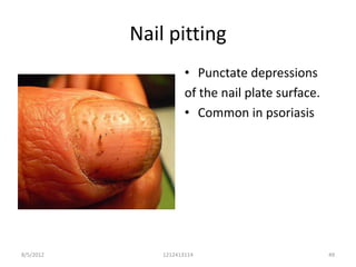 Nail pitting
                      • Punctate depressions
                      of the nail plate surface.
                      • Common in psoriasis




8/5/2012       1212413114                          49
 
