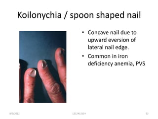 Koilonychia / spoon shaped nail
                          • Concave nail due to
                            upward eversion of
                            lateral nail edge.
                          • Common in iron
                            deficiency anemia, PVS




8/5/2012           1212413114                        52
 
