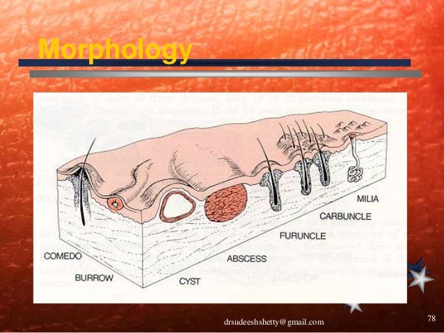 Skin Examination diagram of papules 