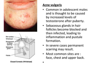 Sebaceous Pustules Skin | PPT