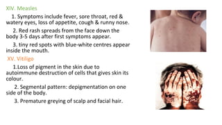 XIV. Measles
1. Symptoms include fever, sore throat, red &
watery eyes, loss of appetite, cough & runny nose.
2. Red rash spreads from the face down the
body 3-5 days after first symptoms appear.
3. tiny red spots with blue-white centres appear
inside the mouth.
XV. Vitiligo
1.Loss of pigment in the skin due to
autoimmune destruction of cells that gives skin its
colour.
2. Segmental pattern: depigmentation on one
side of the body.
3. Premature greying of scalp and facial hair.
 