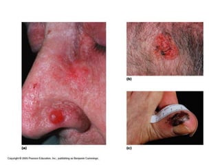 Basal cell carcinoma
Sqaumous cell carcinoma
Melanoma
Skin Cancer
 