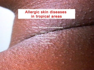 Allergic skin diseases
in tropical areas
Peter Schmid-Grendelmeier
Allergy Unit
Dept. Of Dermatology
University Hospital
Zuerich
Switzerland

 