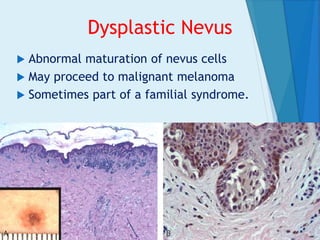 Dysplastic Nevus
 Abnormal maturation of nevus cells
 May proceed to malignant melanoma
 Sometimes part of a familial syndrome.
 