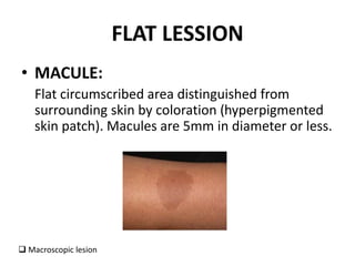 FLAT LESSION
• MACULE:
Flat circumscribed area distinguished from
surrounding skin by coloration (hyperpigmented
skin patch). Macules are 5mm in diameter or less.
 Macroscopic lesion
 