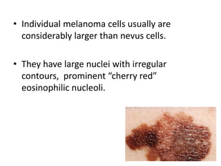 • Individual melanoma cells usually are
considerably larger than nevus cells.
• They have large nuclei with irregular
contours, prominent “cherry red”
eosinophilic nucleoli.
 
