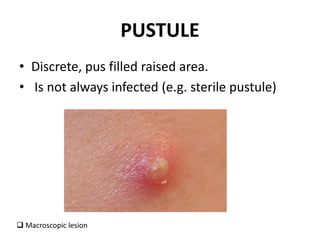 PUSTULE
• Discrete, pus filled raised area.
• Is not always infected (e.g. sterile pustule)
 Macroscopic lesion
 