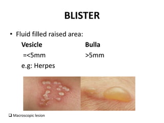 BLISTER
• Fluid filled raised area:
Vesicle Bulla
=<5mm >5mm
e.g: Herpes
 Macroscopic lesion
 