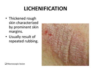 LICHENIFICATION
• Thickened rough
skin characterized
by prominent skin
margins.
• Usually result of
repeated rubbing.
 Macroscopic lesion
 
