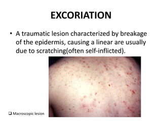 EXCORIATION
• A traumatic lesion characterized by breakage
of the epidermis, causing a linear are usually
due to scratching(often self-inflicted).
 Macroscopic lesion
 