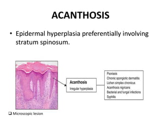 ACANTHOSIS
• Epidermal hyperplasia preferentially involving
stratum spinosum.
 Microscopic lesion
 