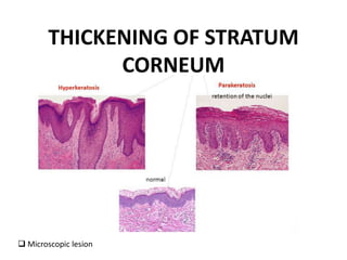 THICKENING OF STRATUM
CORNEUM
 Microscopic lesion
 