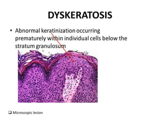 DYSKERATOSIS
 Microscopic lesion
 