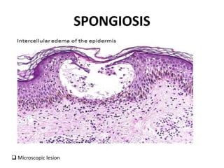 SPONGIOSIS
 Microscopic lesion
 