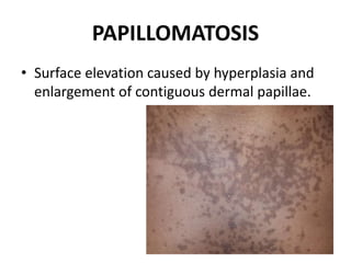 PAPILLOMATOSIS
• Surface elevation caused by hyperplasia and
enlargement of contiguous dermal papillae.
 