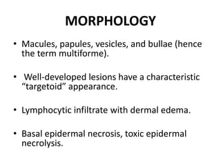 MORPHOLOGY
• Macules, papules, vesicles, and bullae (hence
the term multiforme).
• Well-developed lesions have a characteristic
“targetoid” appearance.
• Lymphocytic infiltrate with dermal edema.
• Basal epidermal necrosis, toxic epidermal
necrolysis.
 