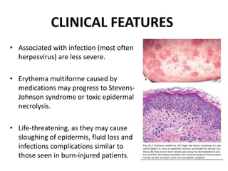 CLINICAL FEATURES
• Associated with infection (most often
herpesvirus) are less severe.
• Erythema multiforme caused by
medications may progress to Stevens-
Johnson syndrome or toxic epidermal
necrolysis.
• Life-threatening, as they may cause
sloughing of epidermis, fluid loss and
infections complications similar to
those seen in burn-injured patients.
 