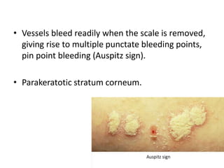• Vessels bleed readily when the scale is removed,
giving rise to multiple punctate bleeding points,
pin point bleeding (Auspitz sign).
• Parakeratotic stratum corneum.
 