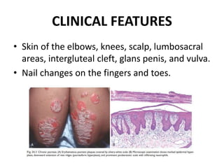 CLINICAL FEATURES
• Skin of the elbows, knees, scalp, lumbosacral
areas, intergluteal cleft, glans penis, and vulva.
• Nail changes on the fingers and toes.
 
