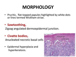 MORPHOLOGY
• Pruritic, flat-topped papules highlighted by white dots
or lines termed Wickham striae.
• Sawtoothing,
Zigzag angulated dermoepidermal junction.
• Civatte bodies,
Anucleated necrotic basal cells
• Epidermal hyperplasia and
hyperkeratosis.
 