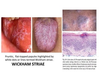 WICKHAM STRIAE
Pruritic, flat-topped papules highlighted by
white dots or lines termed Wickham striae.
 