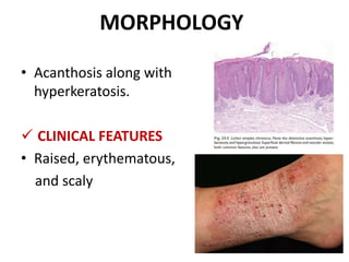MORPHOLOGY
• Acanthosis along with
hyperkeratosis.
 CLINICAL FEATURES
• Raised, erythematous,
and scaly
 