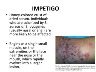 IMPETIGO
• Honey-colored crust of
dried serum. Individuals
who are colonized by S.
aureus or S. pyogenes
(usually nasal or anal) are
more likely to be affected.
• Begins as a single small
macule, on the
extremities or the face
near the nose or the
mouth, which rapidly
evolves into a larger
lesion.
 