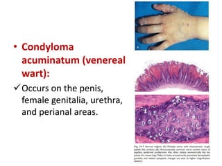 • Condyloma
acuminatum (venereal
wart):
Occurs on the penis,
female genitalia, urethra,
and perianal areas.
 