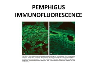 PEMPHIGUS
IMMUNOFLUORESCENCE
 