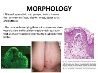 MORPHOLOGY
• Bilateral, symmetric, and grouped lesions involve
the extensor surfaces, elbows, knees, upper back,
and buttocks.
• The basal cells overlying these microabscesses show
vacuolization and focal dermoepidermal separation
that ultimately coalesce to form a true subepidermal
blister.
 