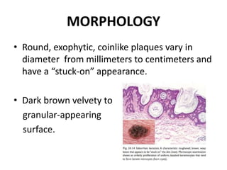 MORPHOLOGY
• Round, exophytic, coinlike plaques vary in
diameter from millimeters to centimeters and
have a “stuck-on” appearance.
• Dark brown velvety to
granular-appearing
surface.
 