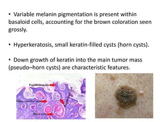 • Variable melanin pigmentation is present within
basaloid cells, accounting for the brown coloration seen
grossly.
• Hyperkeratosis, small keratin-filled cysts (horn cysts).
• Down growth of keratin into the main tumor mass
(pseudo–horn cysts) are characteristic features.
 