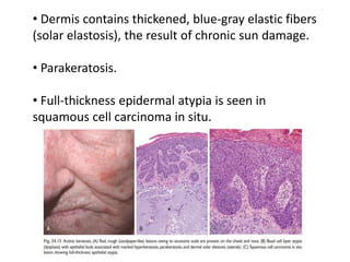 • Dermis contains thickened, blue-gray elastic fibers
(solar elastosis), the result of chronic sun damage.
• Parakeratosis.
• Full-thickness epidermal atypia is seen in
squamous cell carcinoma in situ.
 