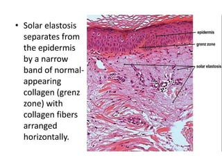 • Solar elastosis
separates from
the epidermis
by a narrow
band of normal-
appearing
collagen (grenz
zone) with
collagen fibers
arranged
horizontally.
 