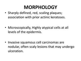 MORPHOLOGY
• Sharply defined, red, scaling plaques;
association with prior actinic keratoses.
• Microscopically, Highly atypical cells at all
levels of the epidermis.
• Invasive squamous cell carcinomas are
nodular, often scaly lesions that may undergo
ulceration.
 