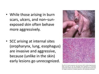 • While those arising in burn
scars, ulcers, and non–sun-
exposed skin often behave
more aggressively.
• SCC arising at internal sites
(oropharynx, lung, esophagus)
are invasive and aggressive,
because (unlike in the skin)
early lesions go unrecognized.
 