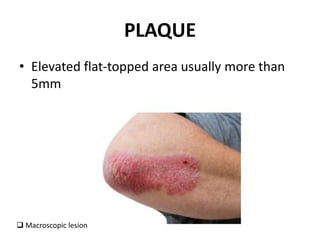 PLAQUE
• Elevated flat-topped area usually more than
5mm
 Macroscopic lesion
 