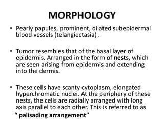 MORPHOLOGY
• Pearly papules, prominent, dilated subepidermal
blood vessels (telangiectasia) .
• Tumor resembles that of the basal layer of
epidermis. Arranged in the form of nests, which
are seen arising from epidermis and extending
into the dermis.
• These cells have scanty cytoplasm, elongated
hyperchromatic nuclei. At the periphery of these
nests, the cells are radially arranged with long
axis parallel to each other. This is referred to as
“ palisading arrangement”
 